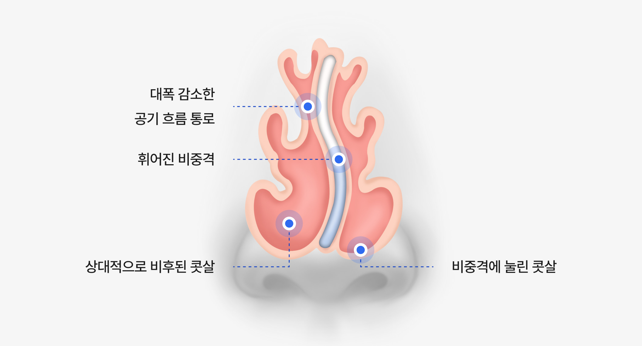 휘어진 비중격과 좁아진 공기 흐름을 보여주는 비강 구조 일러스트