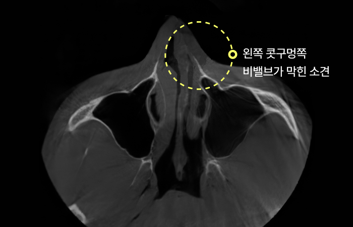 왼쪽 콧구멍 비밸브 막힘 소견이 표시된 비강 구조 CT