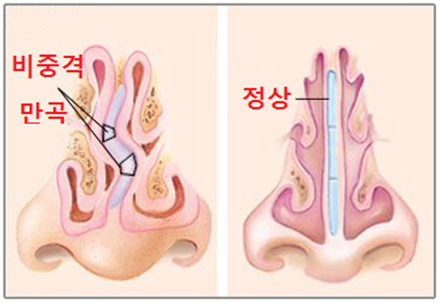 매부리코성형