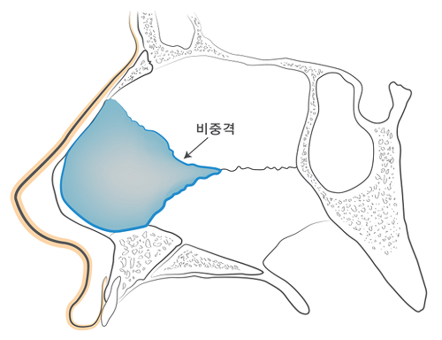 비중격만곡증