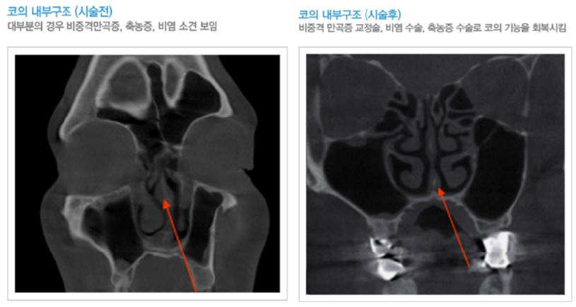 코뼈골절수술비용