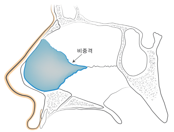 비중격만곡증수술후