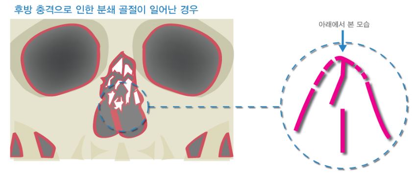 코뼈 골절