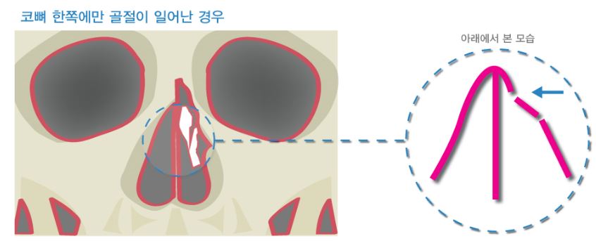 코뼈골절수술