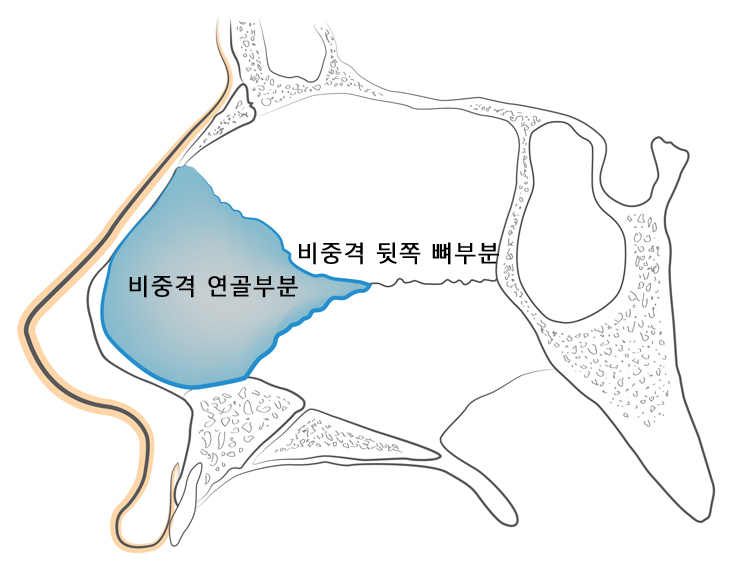 비중격만곡증보험