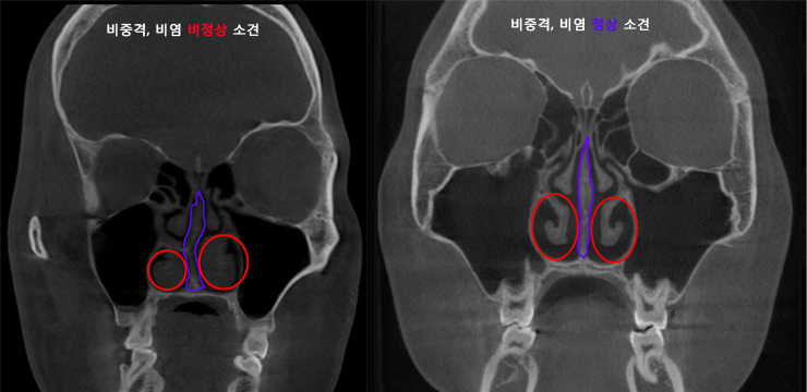 비중격만곡증수술