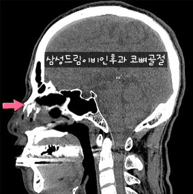 코뼈골절