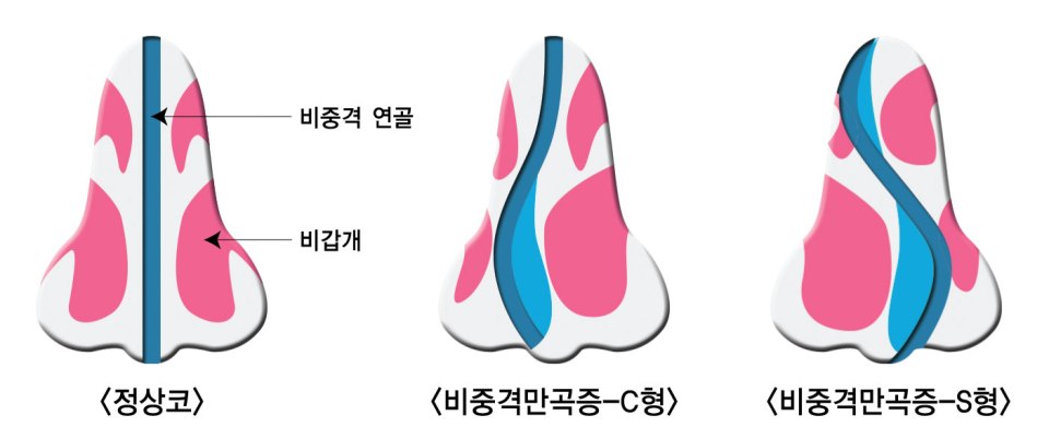 휜코수술가격