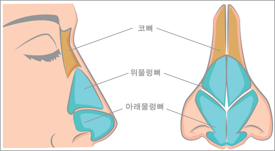 휜코수술