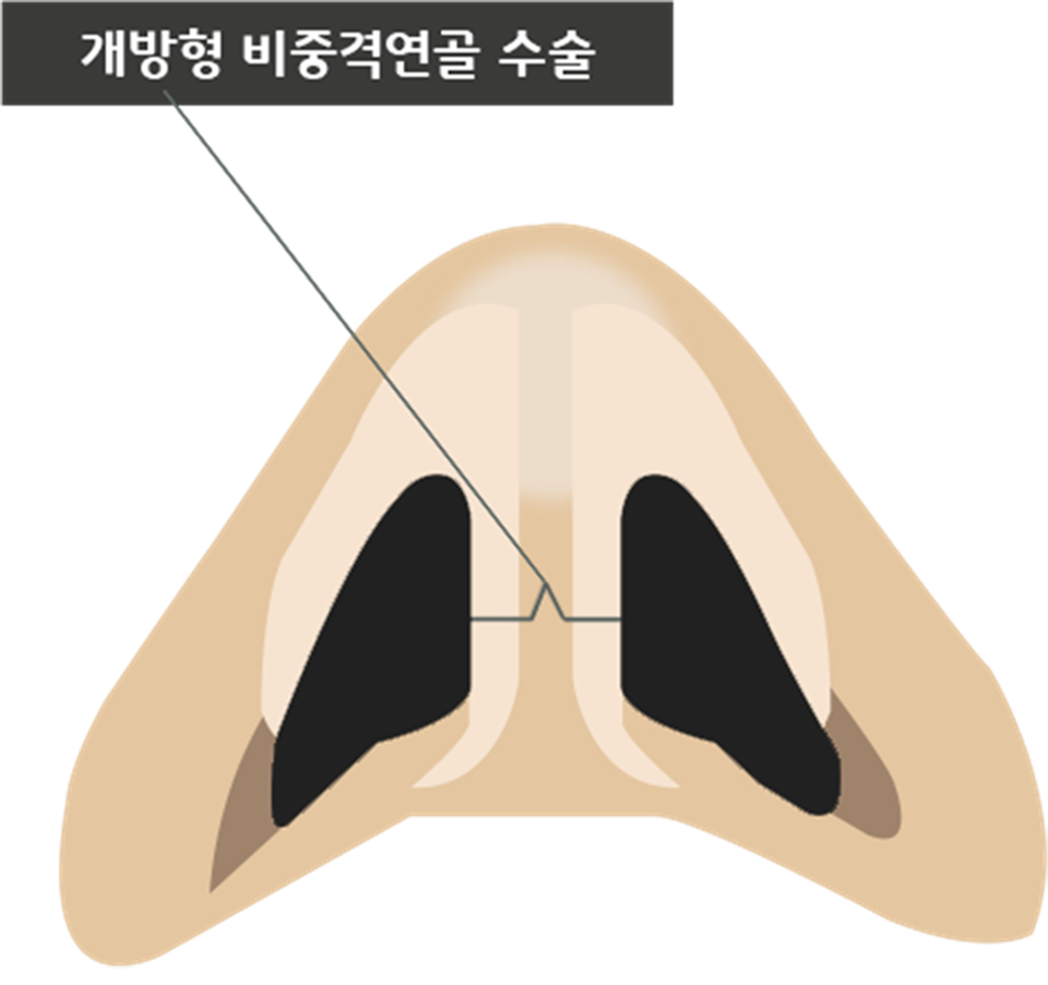 휜코수술가격