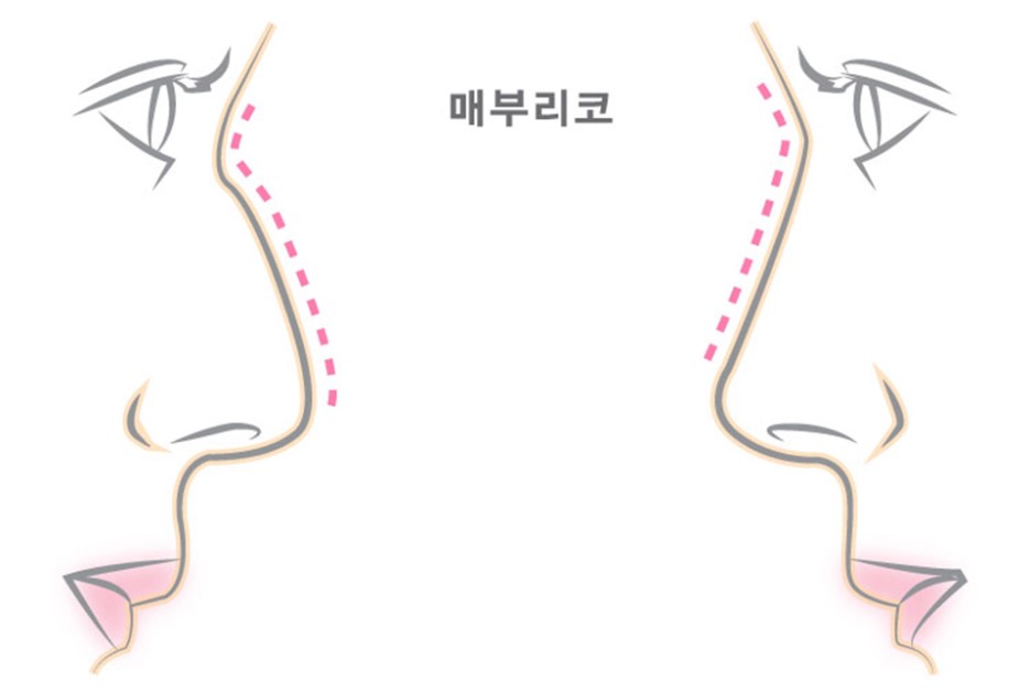 매부리코모양