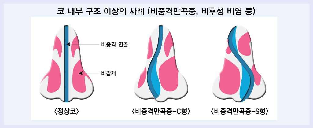 비염 수술 가격