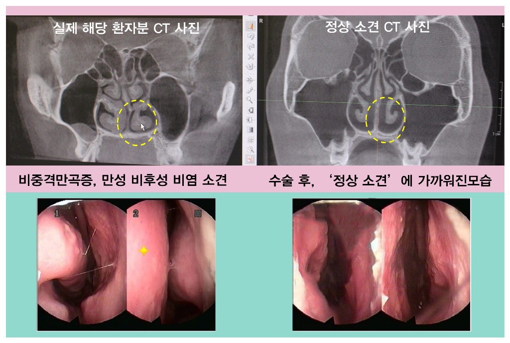 비염 수술