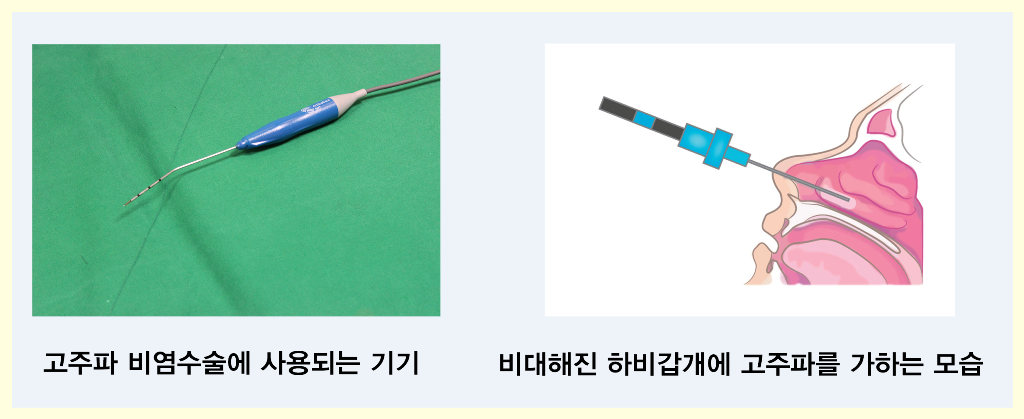 비염 수술가격