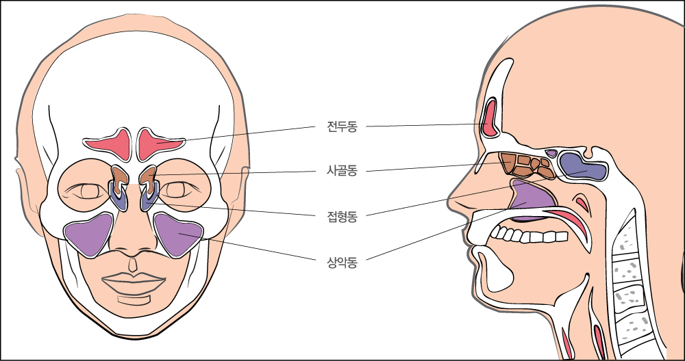 부비동염