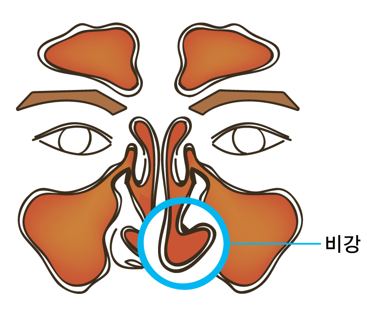 비염수술후기