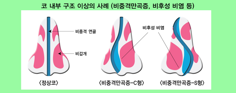 비중격만곡증 증상