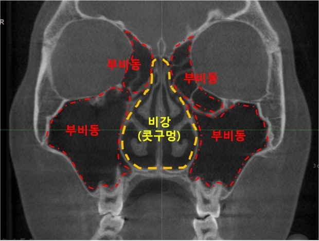 비염과 축농증