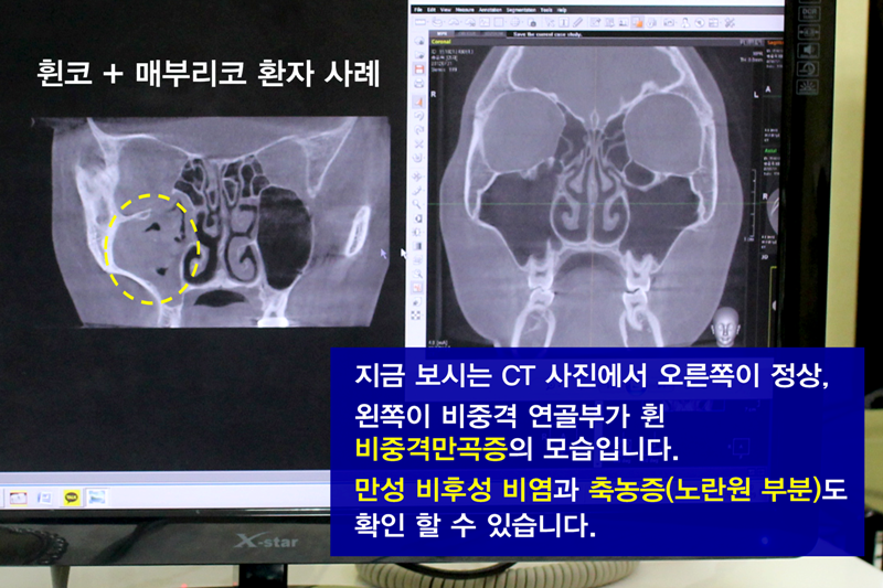 비중격만곡증 증상