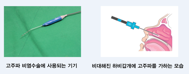 비염 수술 재발