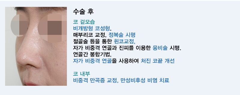 코뼈 골절 가격