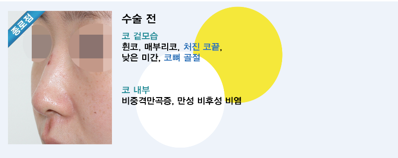 코뼈골절 수술