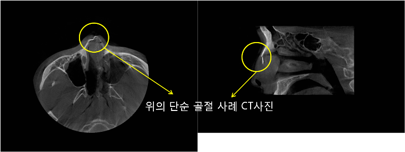 코뼈골절가격