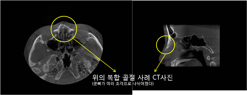 코뼈 골절 수술