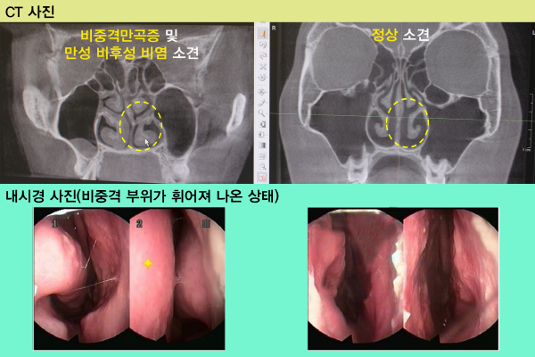 비염 수술