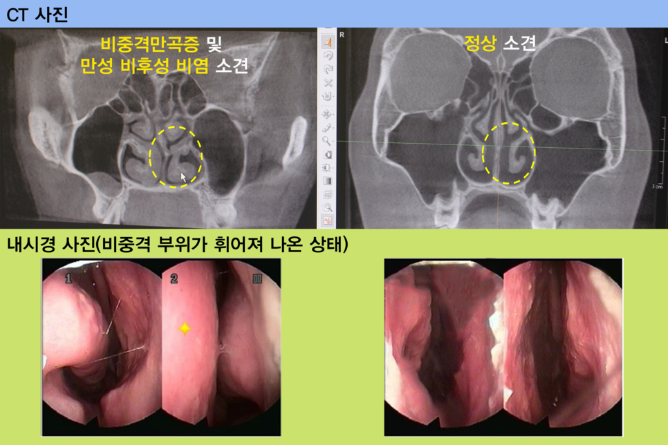 비중격만곡증수술