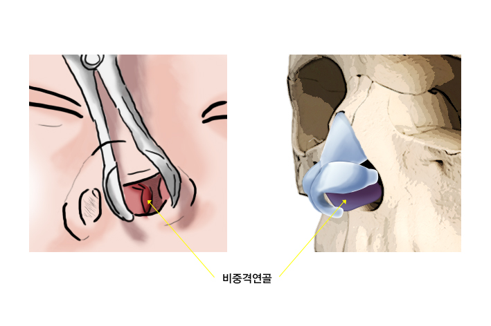 비중격연골