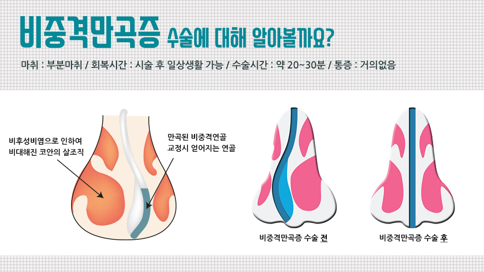 비중격만곡증 코성형