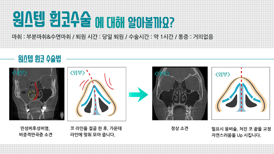  휜코재 수술