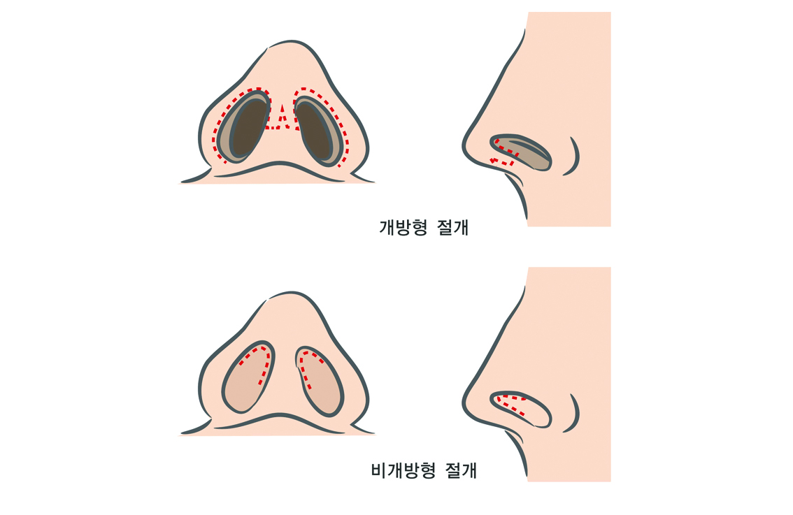 비개방코성형