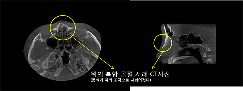 코골절