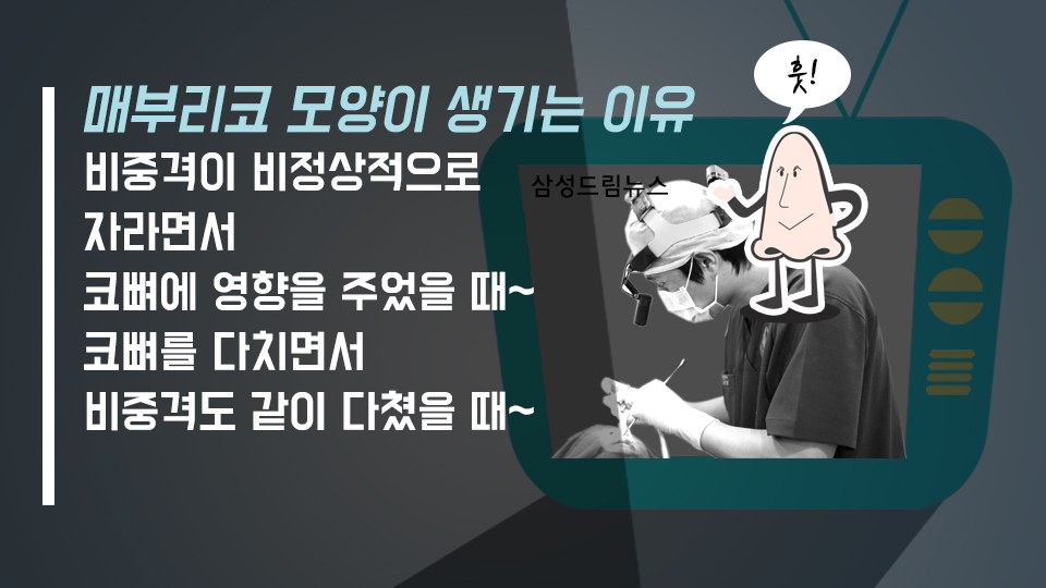 매부리코 성형가격