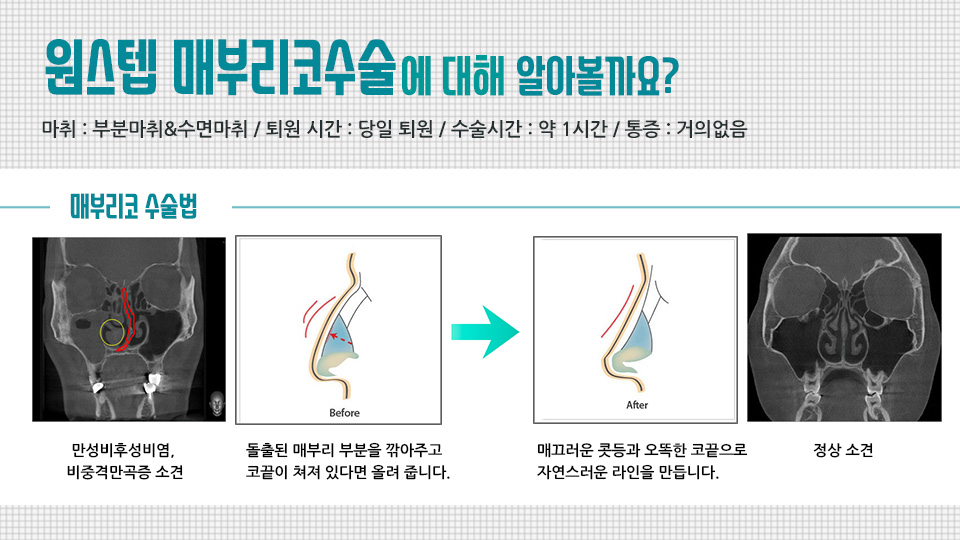 메부리코교정