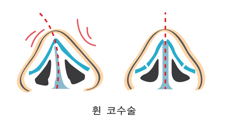 휜코수술비용