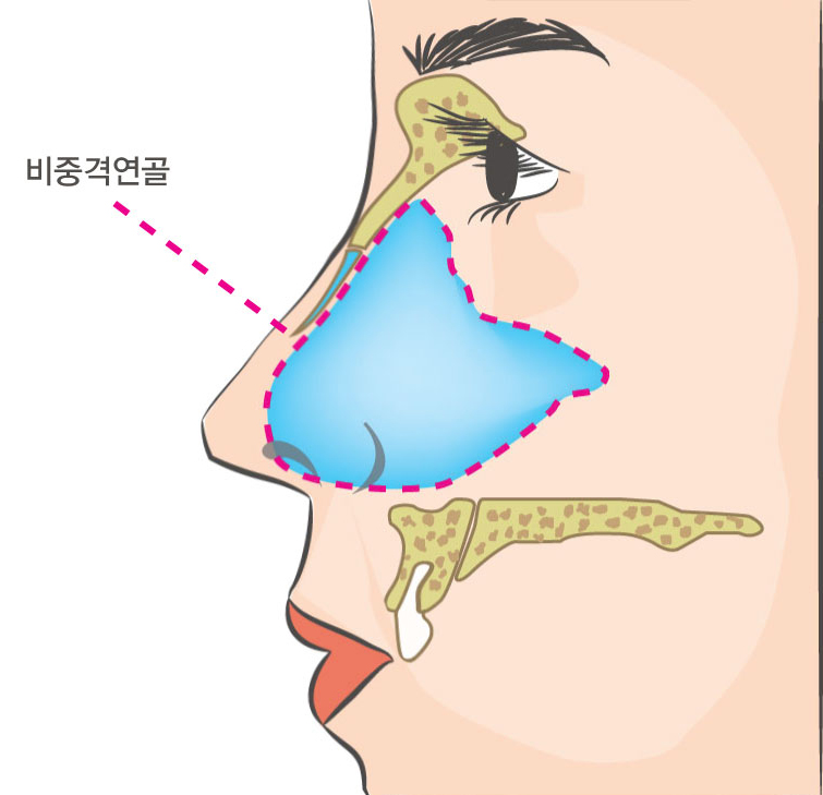 휜코 교정비용