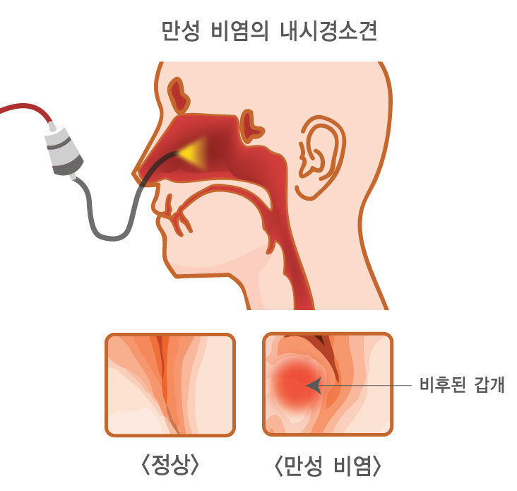 고주파비염수술