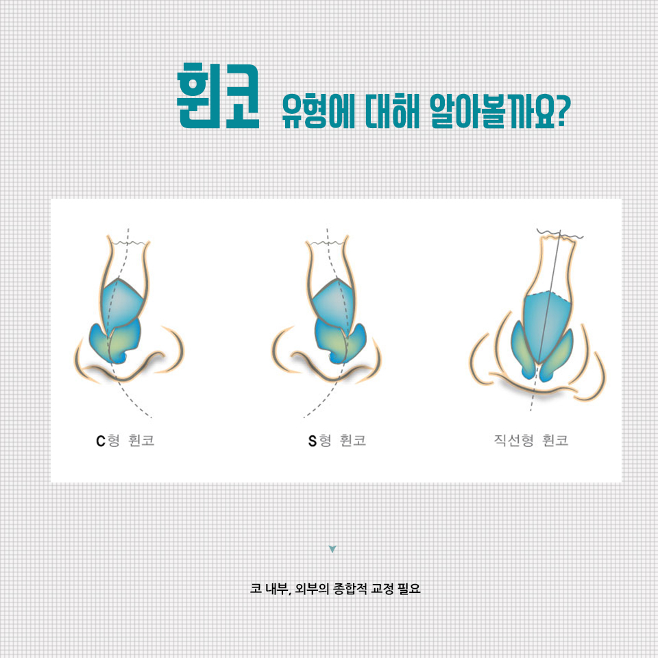 군인휜코 수술