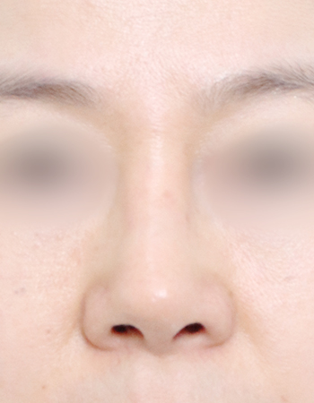 코성형 전후사진