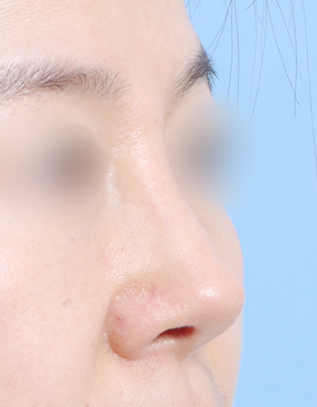 코성형 전후사진