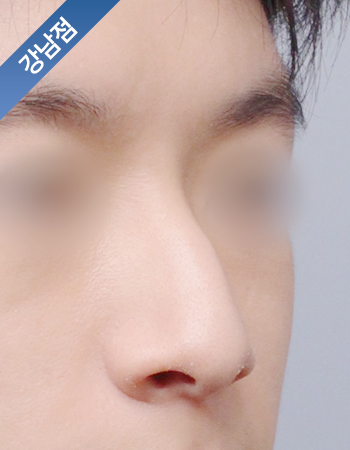 코성형 전후사진