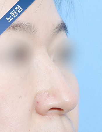 코성형 전후사진