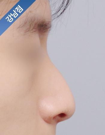 코성형 전후사진