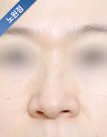 코성형 전후사진