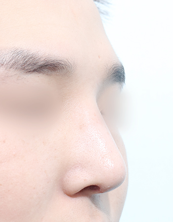 코성형 전후사진