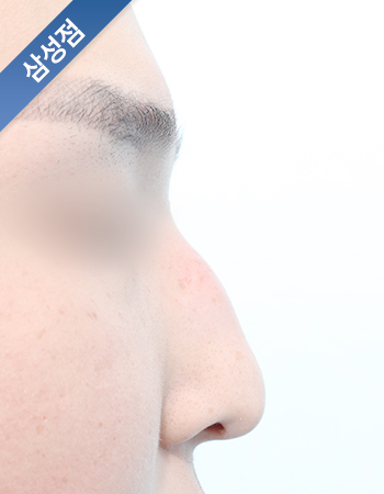 코성형 전후사진