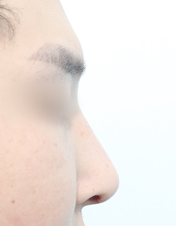 코성형 전후사진